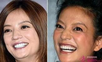 明星法令纹,揭秘如何有效淡化法令纹